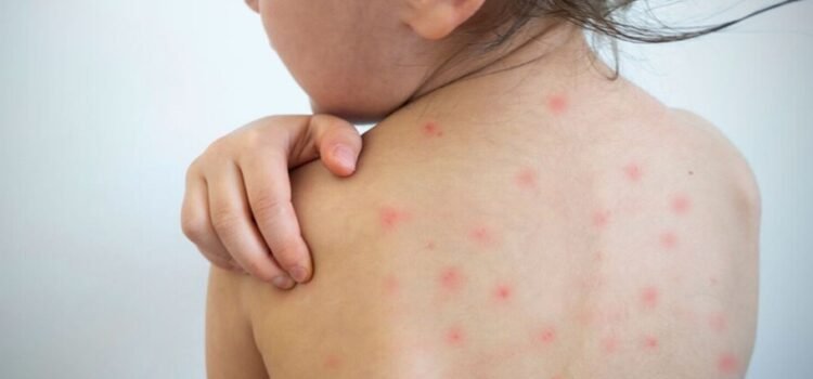 Cuatro casos confirmados de sarampión en Nayarit