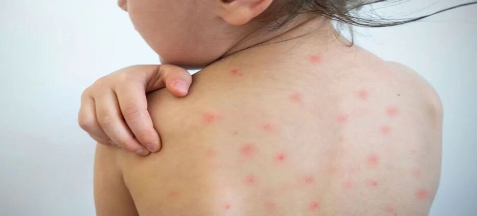 Nayarit entre los siete estados con transmisión significativa de sarampión