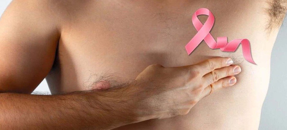 Detectan casos de cáncer de mama en hombres en Nayarit durante 2026